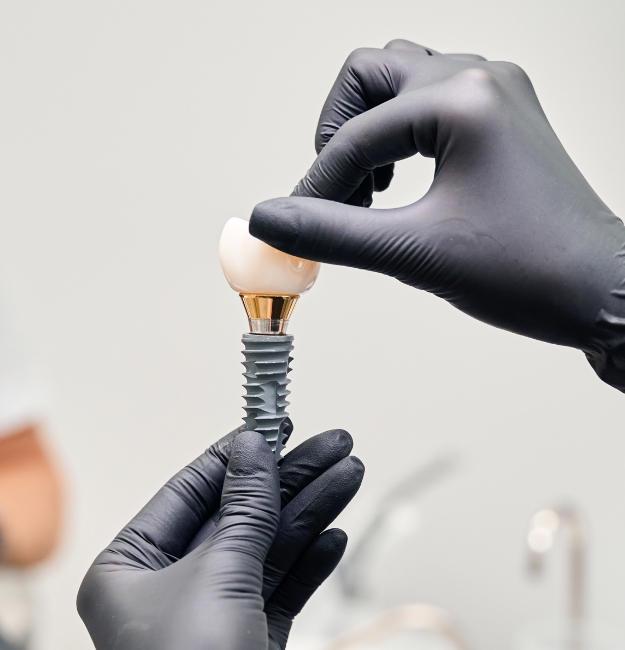 Qu’est-ce qu’un implant dentaire ?